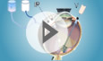 Floater Vitrectomy